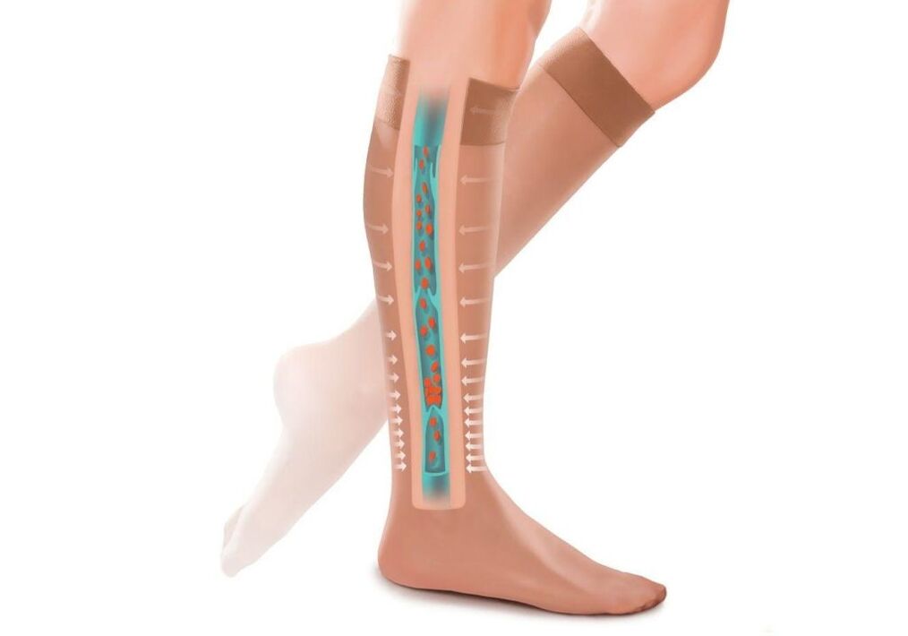 воздействие компрессионных чулок на ноги при варикозе