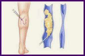Склеротерапия – популярный метод избавления от варикоза на ногах
