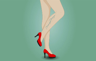 Варикозное расширение вен на ногах у женщины