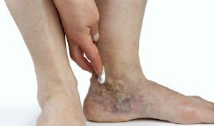 проявления варикоза вен на ногах